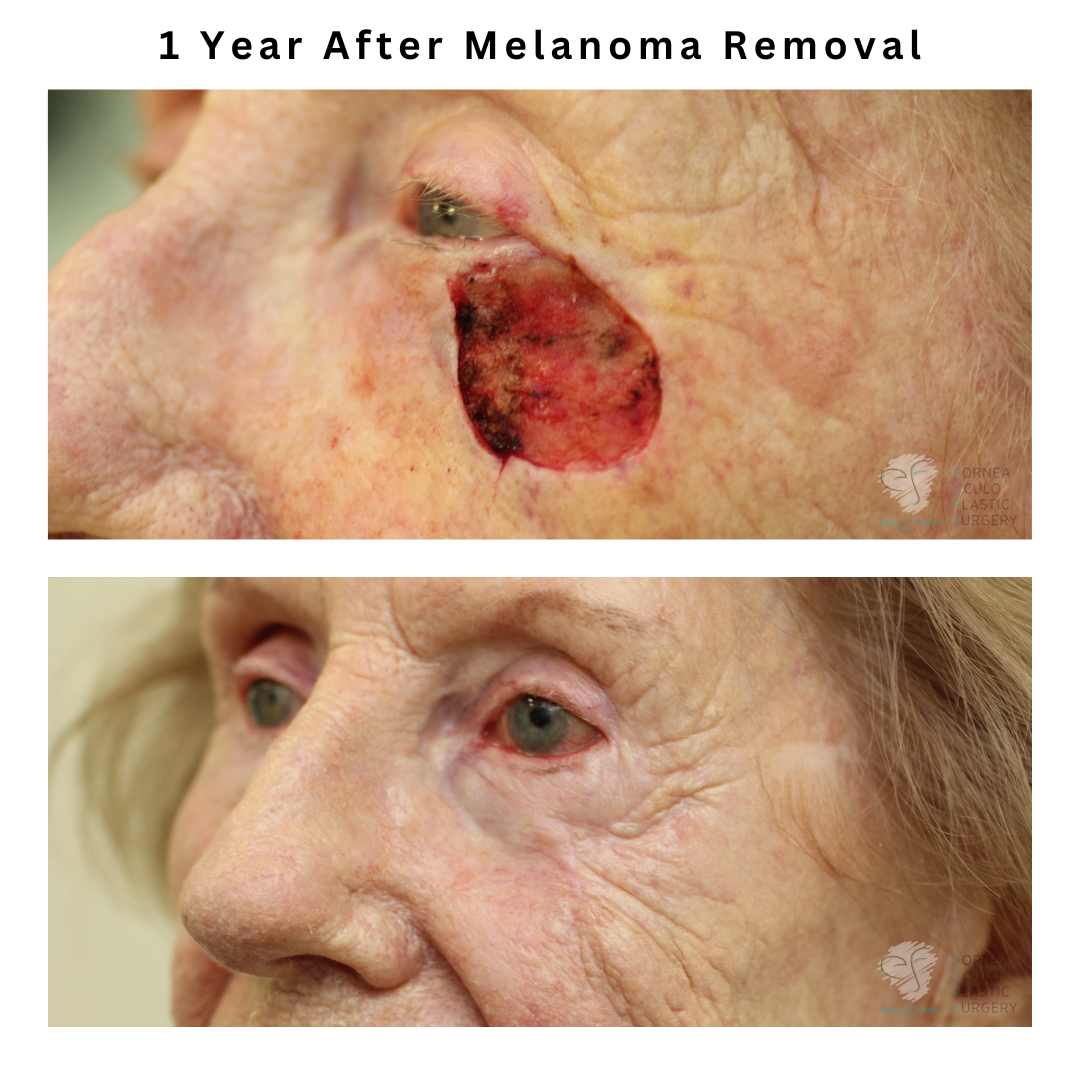 1 year after melanoma removal via Mohs surgery. Mohs reconstruction performed by Dr Anthony Maloof in Sydney.